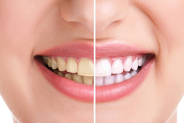 dentist in pimple saudagar