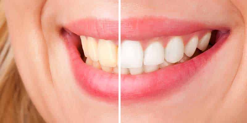 Things You Have To Know About Teeth Whitening